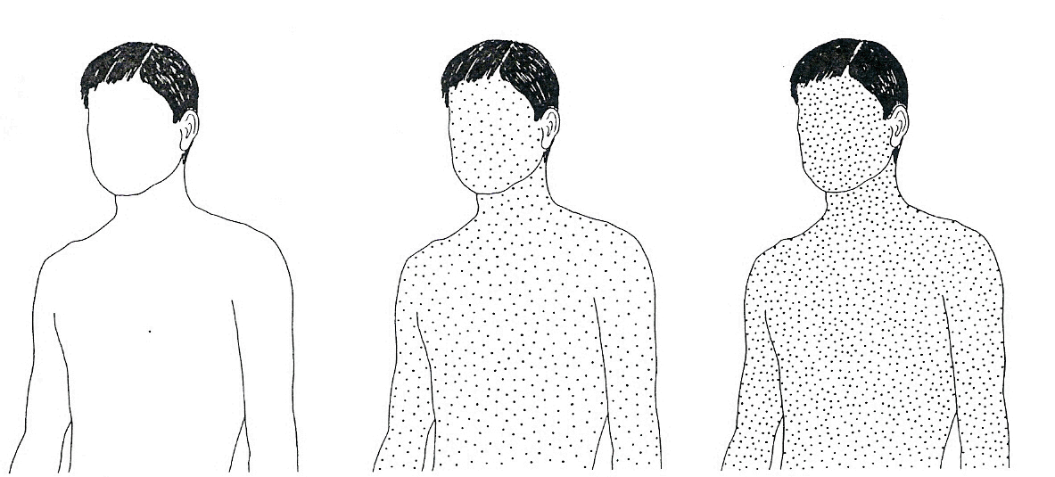 Body burden of lead